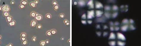 Phase-Contrast Microscopy - Identification Of Elements Of Urinary Sediment