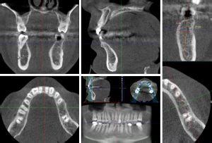 Dental CT scan vs. Cone Beam CT: an overview - ITI Blog