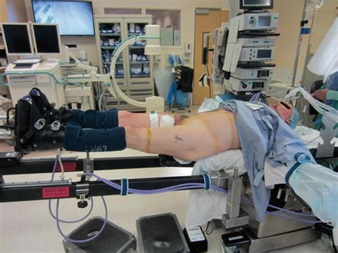 Anterior Approach Total Hip Arthroplasty with an Orthopedic Table | SpringerLink