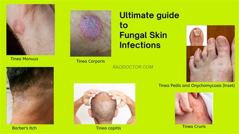 Ultimate Guide To Fungal Skin Infections-How To Tackle Them