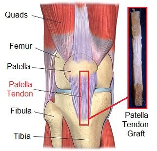 ACL Reconstruction Surgery: Procedure & Recovery - Knee Pain Explained