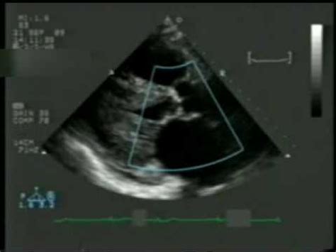 2D Echocardiogram with Doppler - YouTube