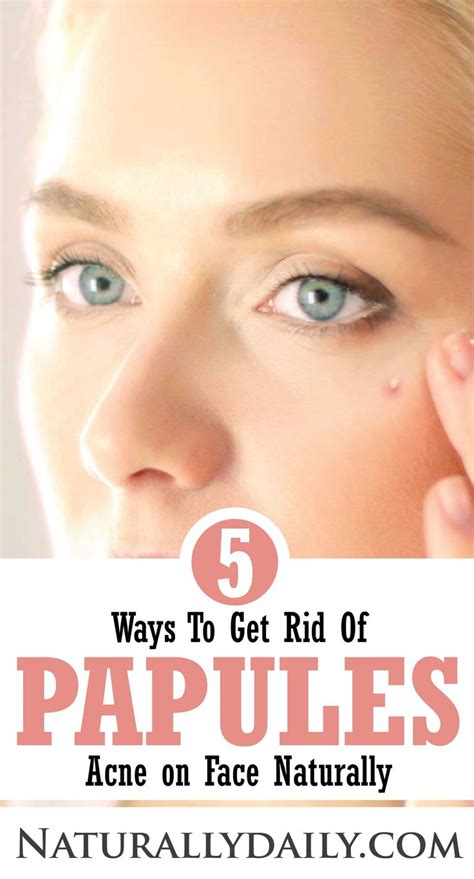 5 Ways to Get Rid of Papules | Papules acne, Home remedies for acne ...