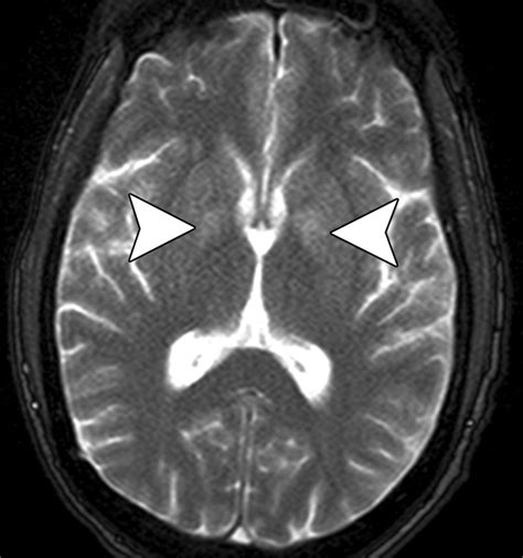 Hypoxic-Ischemic Brain Injury: Imaging Findings from Birth to Adulthood | RadioGraphics