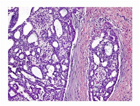 Follicular Thyroid Cancer Diagnosis