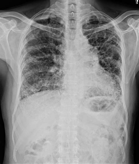 Interstitial Pneumonia X Ray