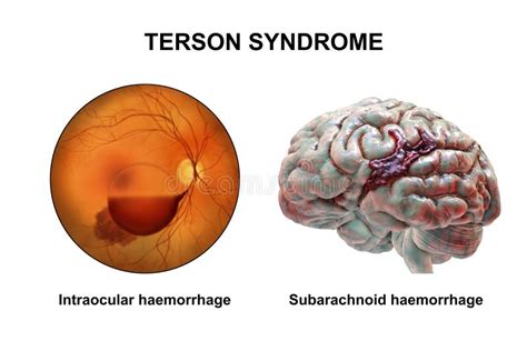 Terson Syndrome Stock Illustrations – 17 Terson Syndrome Stock ...