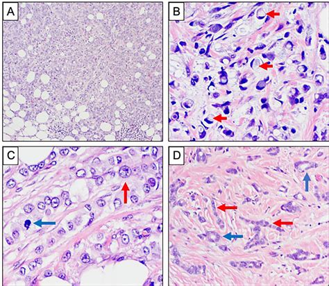 | Morphological variants of invasive lobular carcinoma. (A-D ...