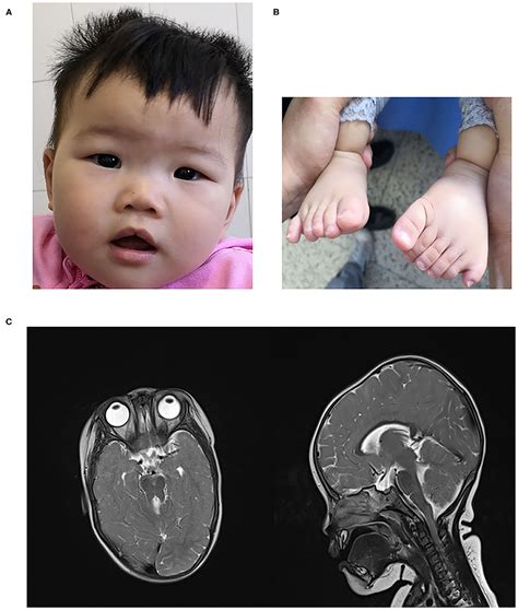 Frontiers | Case Report: Second Report of Joubert Syndrome Caused by Biallelic Variants in IFT74