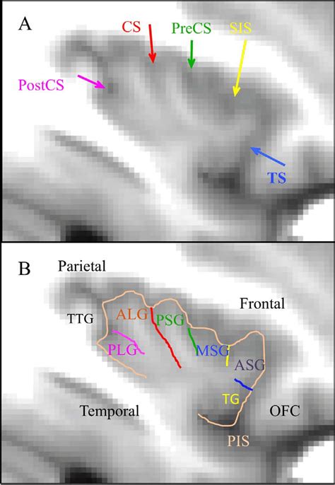 Main structures drawn on left insula of the average MRI of 30 subjects.... | Download Scientific ...