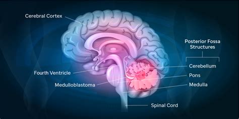 Getting to the bottom of a medulloblastoma mystery | St. Jude Progress