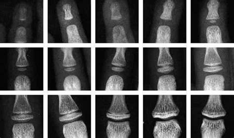 Bone age - Alchetron, The Free Social Encyclopedia