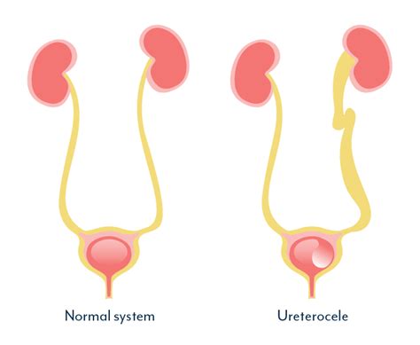 Lower Urinary Tract Symptoms: How to tell if it's really UTI