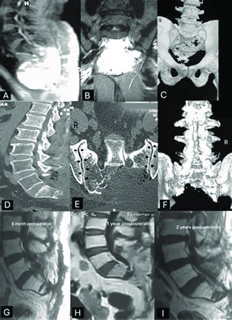 A case of S1/S2-coccyx chordoma. (A) sagittal MRI showing the ...