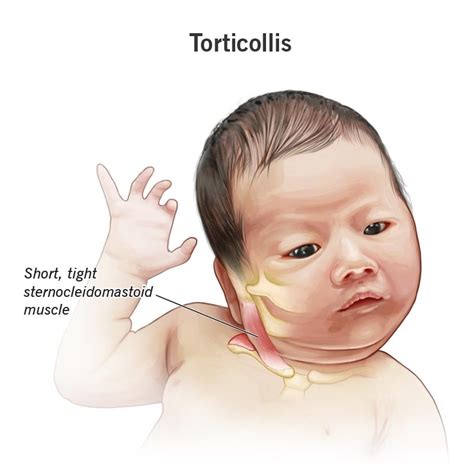 Here Are The Types, Causes, Symptoms and Treatment Of Torticollis