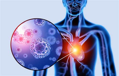 Heart Disease. Viral Infection Stock Illustration - Illustration of warning, pathogenic: 278525986