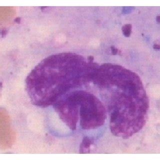 Bone marrow aspirate cytology showing hemophagocytosis in cases of... | Download Scientific Diagram