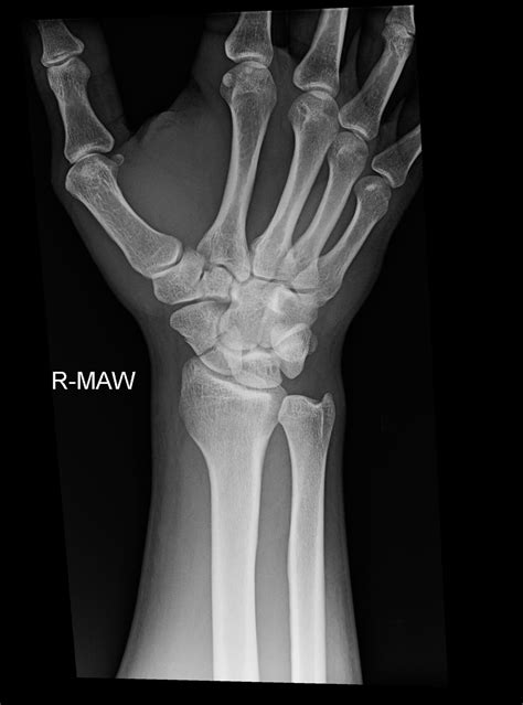 OrthoDx: Scaphoid Fracture - Clinical Advisor