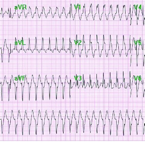 Electrogram of fascicular VT showing termination of VT to sinus rhythm ...