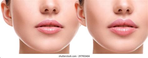 Before After Lip Filler Injections Fillers Stock Photo (Edit Now) 264778757