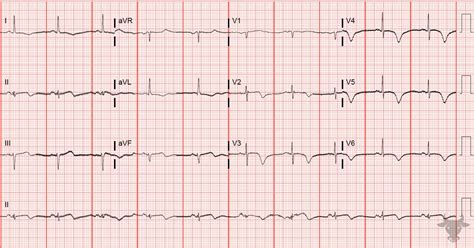 Wellens Syndrome | ECG Stampede