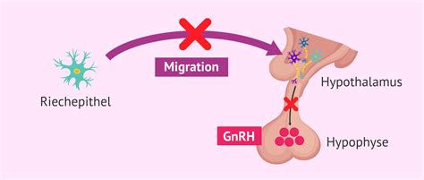 GnRH-Mangel beim Kallmann-Syndrom