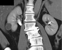 Septated Complex Cyst - Kidney Case Studies - CTisus CT Scanning