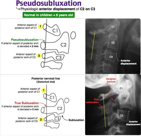 pseudosubluxation - C2 anterior displacement - Ortho - MSK - ER | Nursing school survival ...