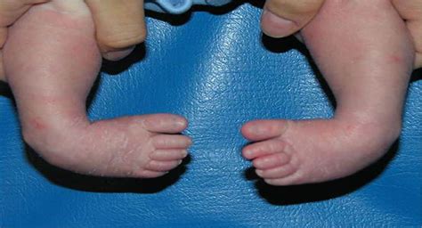 A Brief Discussion about Clubfoot – Causes and Treatment – MEDICAL ISLAND