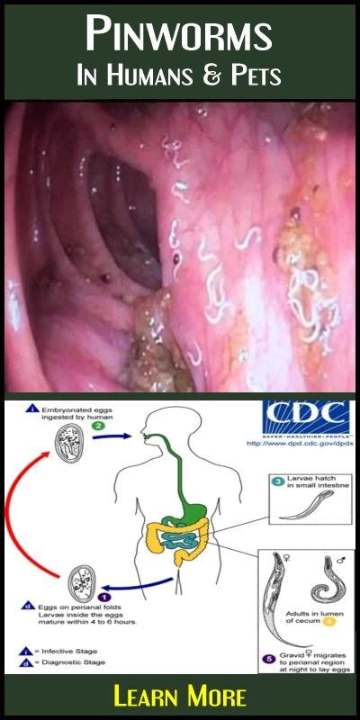 8 Best How to treat pinworms ideas in 2021 | how to treat pinworms, pin ...