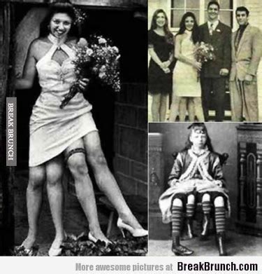 Quick Facts About Myrtle Corbin, A Lady Born With Two Set Of Legs (Pics ...