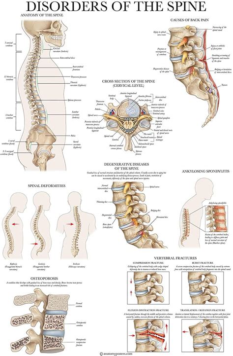 Buy Palace Learning Disorders of the Spine Anatomy - Laminated Spinal Disorders Anatomical Chart ...