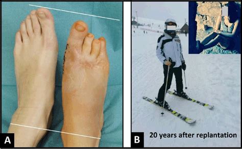 FULL TEXT - A 20-year follow-up after replantation of the right midfoot in an eight-year-old ...