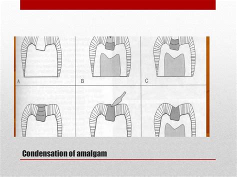 procedure for amalgam restoration