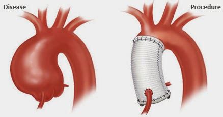 Jim's Bicuspid Heart Valve Diary: Modified Bentall: Low Incidence Of ...