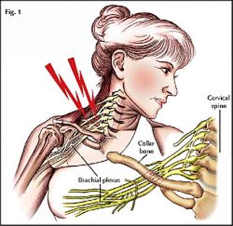 Stinger Injury to the Shoulder and Neck in Rugby - Knee & Sports Injury Clinic