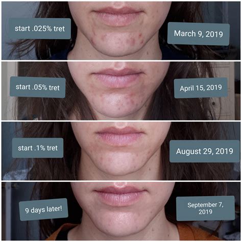 Personal experience: Every increase in Tret % has improved my acne and ...