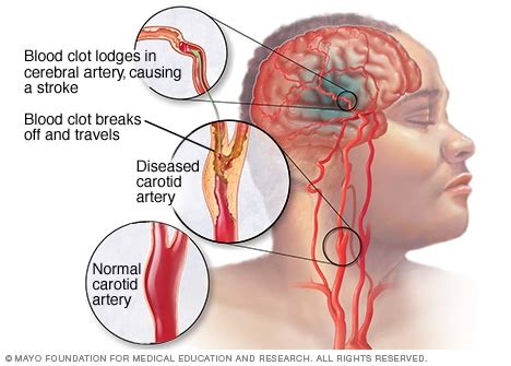 GABA as a Biomarker of Stroke – SIRE299/RPP 2017 (Michael Thees's Section)