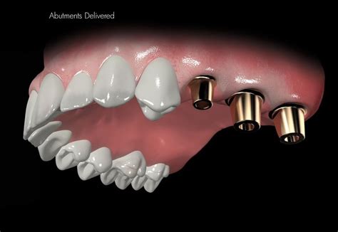 Bone Graft Swansea | Sinus Lift | Dental Implants Swansea