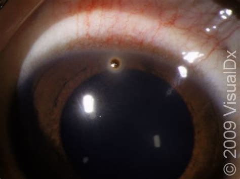 Corneal Foreign Body: Symptoms, Treatment, and Removal