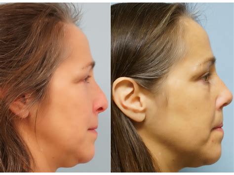 Facial Plastic Surgery: Septal perforation repair, Rhinoplasty ...