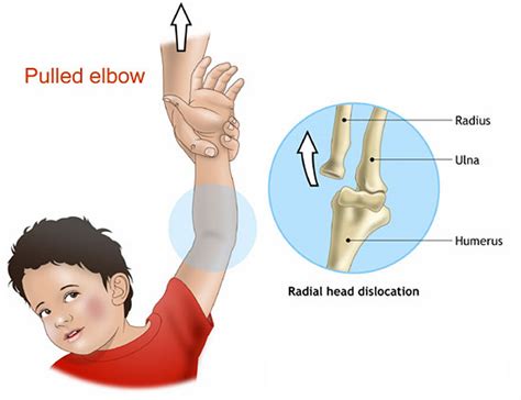 Dislocated Elbow - Causes, Signs, Symptoms, Recovery & Treatment