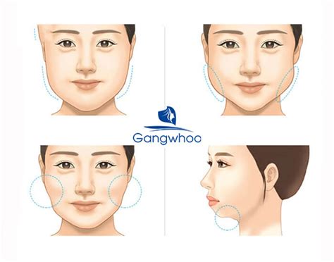 Laser Endoscopic Double Chin Lipo - A Quick Goodbye To Your Double Chin - Gangwhoo Cosmetic ...