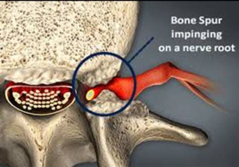 Pin on Detailed Information about Bulging Disc: