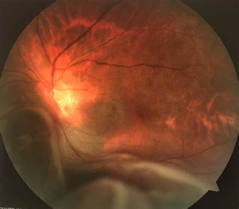 Cureus | Hidden Choroidal Melanoma Presented with Bullous Non ...