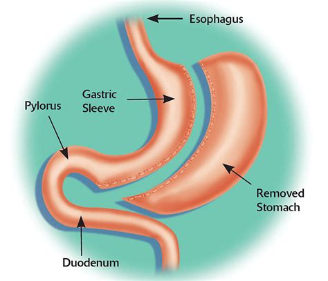 Roux En Y Gastric Bypass vs Sleeve Gastrectomy - Which One is Best for You?