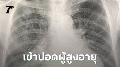 Outbreak of Human Metapneumovirus (hMPV) in Thailand: Case Study and Treatment Insights from Dr ...