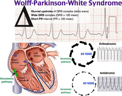 Rapid Review: Wolff-Parkinson-White (WPW) Syndrome - RoshReview.com