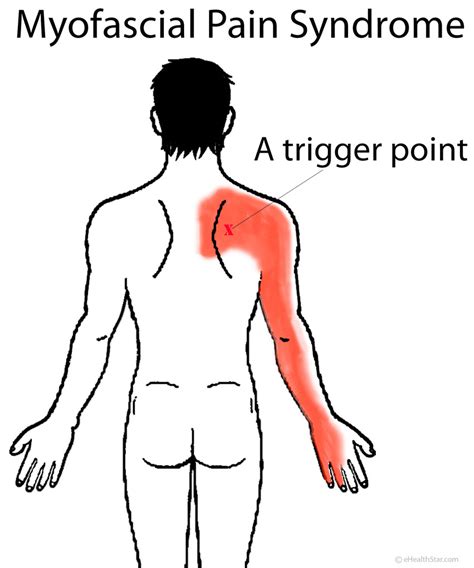 Acid Reflux Symptoms Pain Between Shoulder Blades