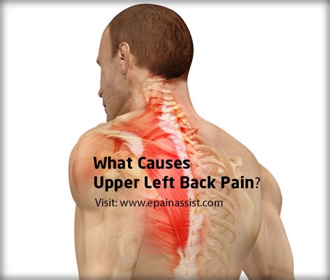 Upper Left Back Pain|Causes|Symptoms|Treatment|Diagnosis